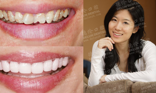 案例 牙齿美白案例 人物:陈怡 35岁 牙齿症状:黄牙,牙