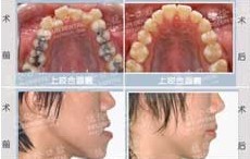 矫正歪牙，“美美”上大学去